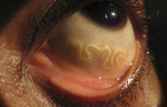 Červ Loa Loa žije v ľudskom oku a spôsobuje slepotu